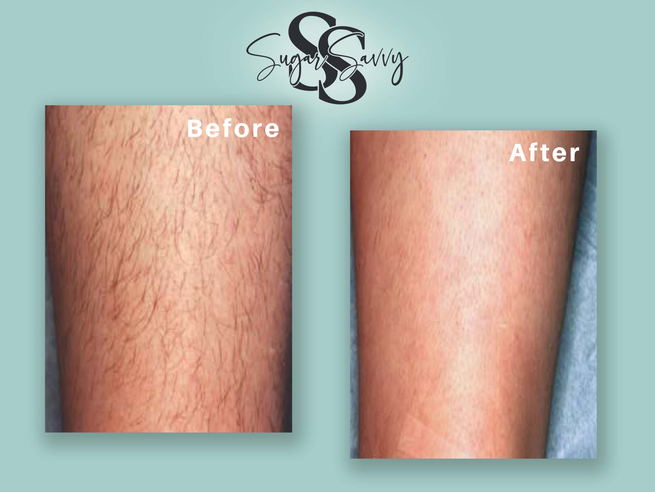 Laser Hair Removal Kitchener | Sugar Savvy