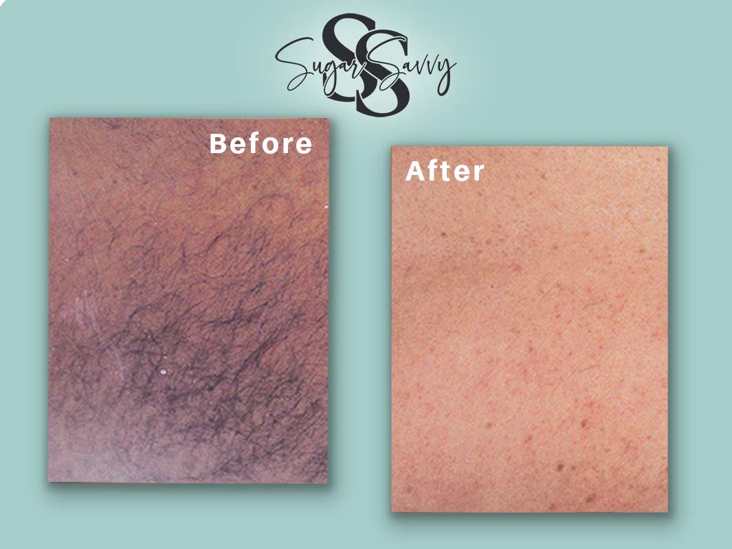 Laser hair removal at Sugar Savvy in Kitchener